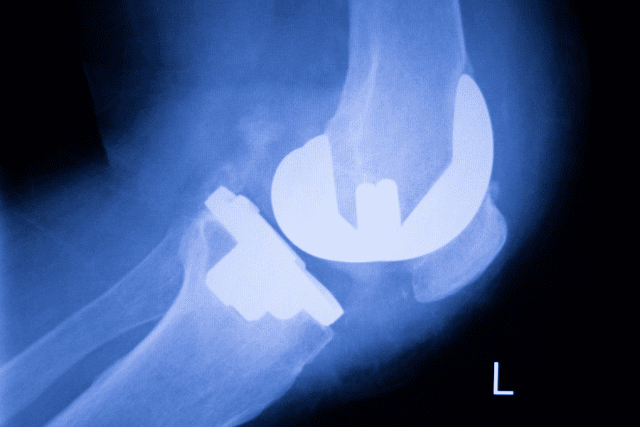 X-Ray showing a replaced knee joint